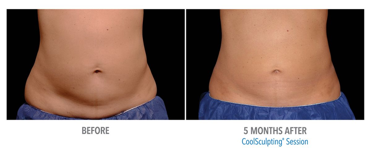 Female Abdomen, Photo Courtesy of Bodify and Steven Sorr3.jpg