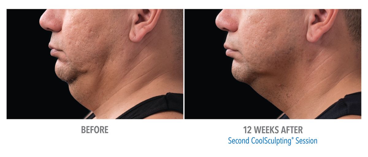 Male Submentum, Dr. Burns_medium.jpg