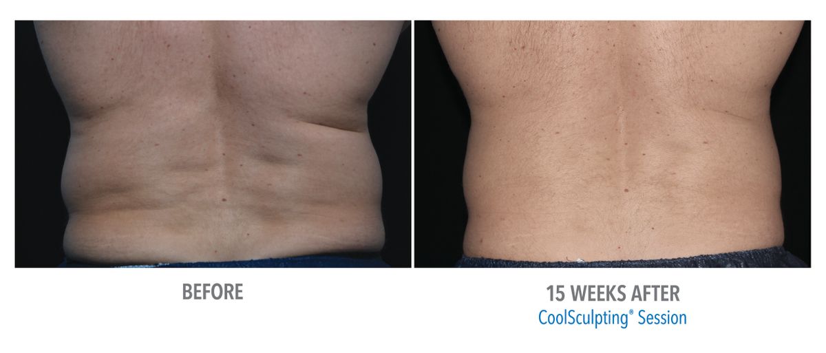 Male Flanks, Back View, Dr. Gerrish.jpg