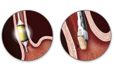 PA GI Procedures PA GI Pennsylvania Gastroenterology PA GI Procedures PA GI Pennsylvania Gastroenterology