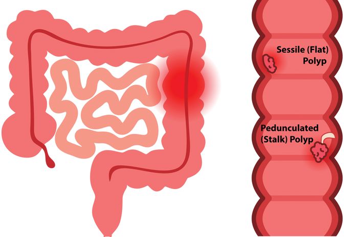 PAGI-Web-Colon-Polyp-Image.jpg