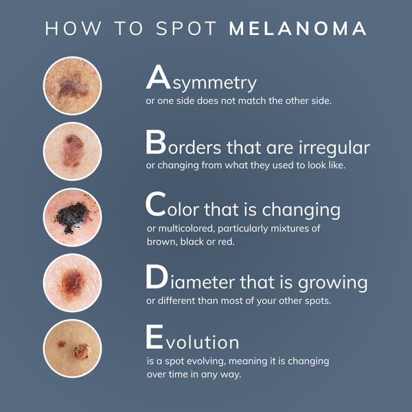 Derm-Physicians-050321-Social-Melanoma-v3.jpg