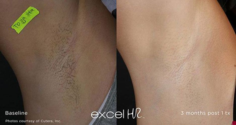 excel-HR_Hair_3-Armpit-hair-removal-excel-hr-DCA-Lafayette-LA.jpg