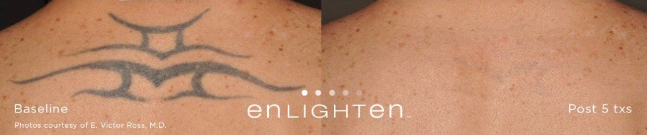 Laser Tattoo Removal