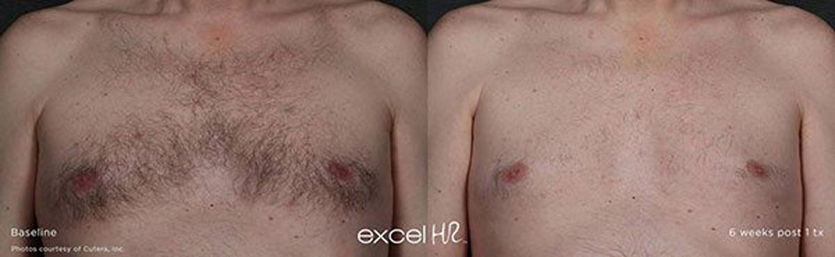 excel-HR_Hair_chest-laser-hair-removal-in-Lafayette-LA.jpg