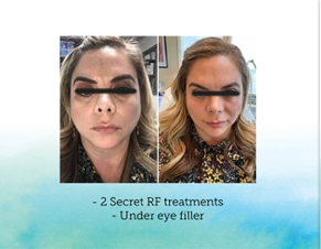 Maria Undereye B&A.png