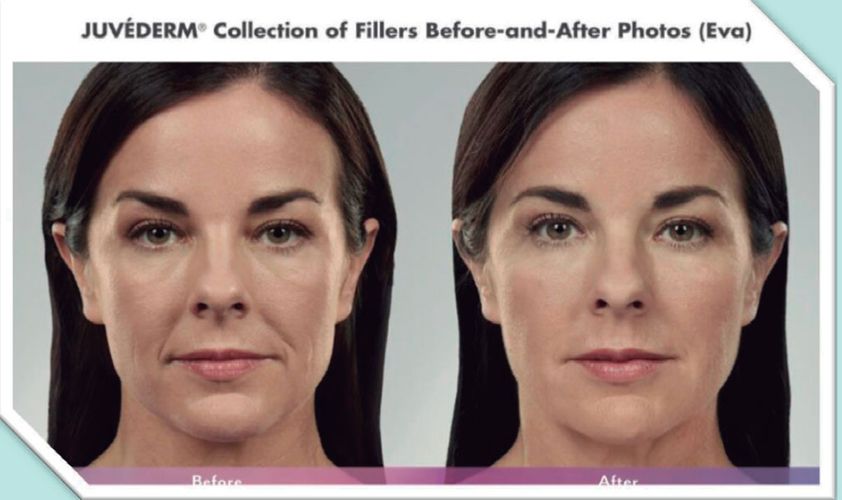 Allergan Fillers