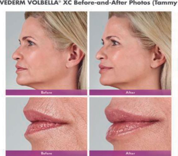 Allergan Fillers