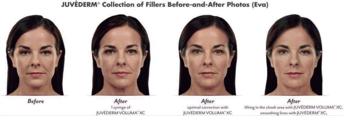 Allergan Fillers