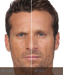 BOTOX-before-and-after-3-Hidden-Door-Medspa-Southlake.jpg