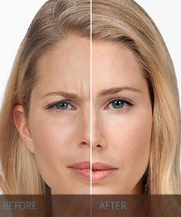 BOTOX-before-and-after-Hidden-Door-Medspa-Southlake-1.jpg