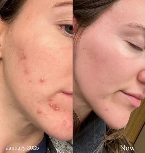 Pensacola Clear Skin Transformation
