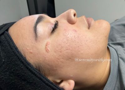 Pensacola Acne Bootcamp Results — Face Reality