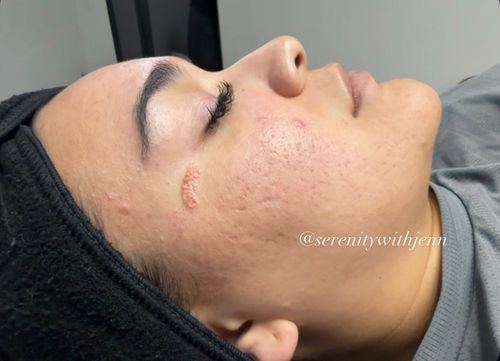 Pensacola Acne Bootcamp Results — Face Reality