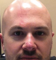 scar therapy 2.png