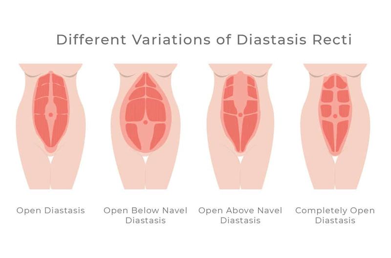 Diastasis-Resti-Ab-Separation-1.jpg