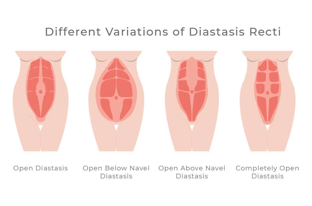 Diastasis-Resti-Ab-Separation-1.jpg