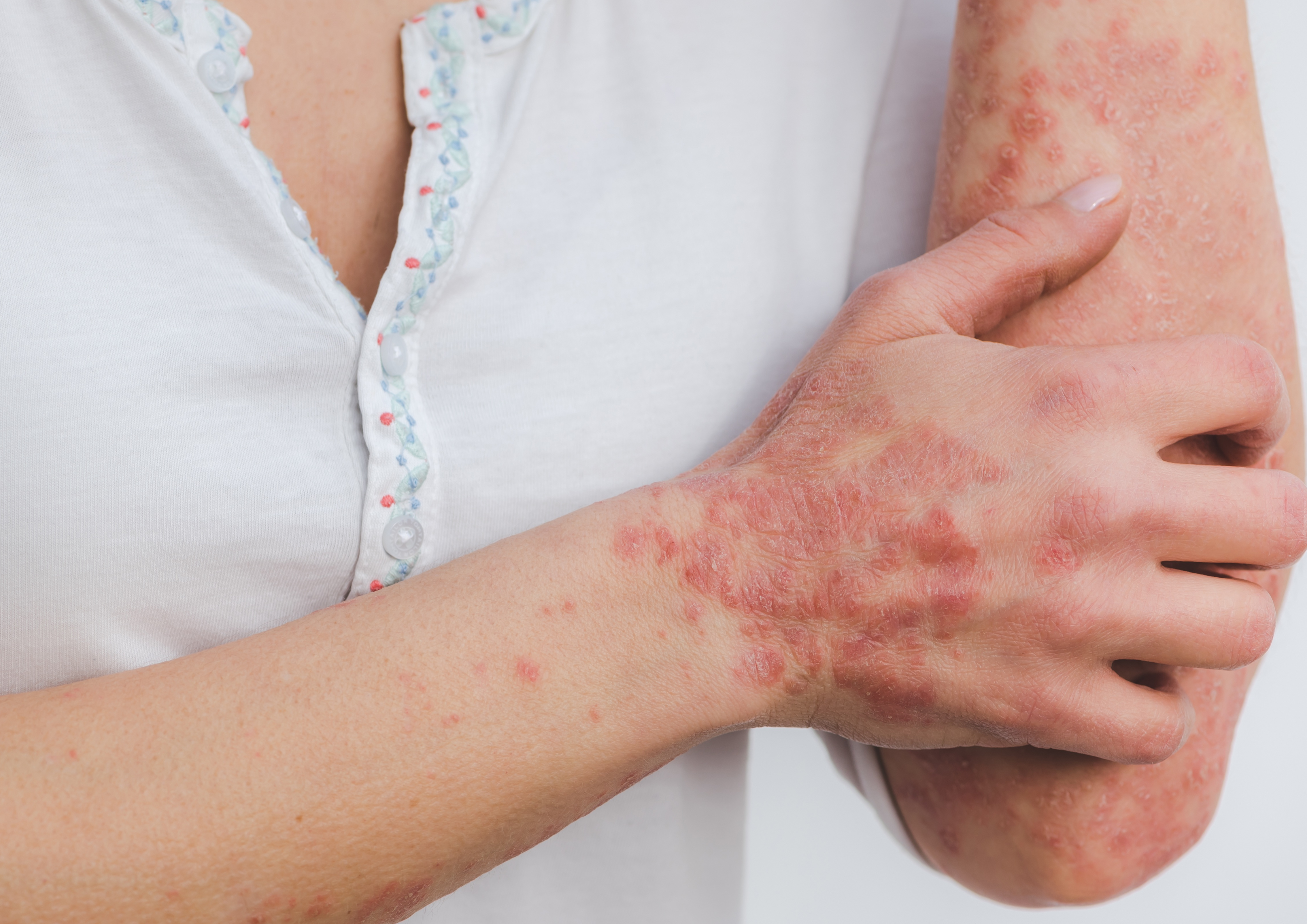 Compounded psoriasis and eczema medications at Rock Ridge Pharmacy