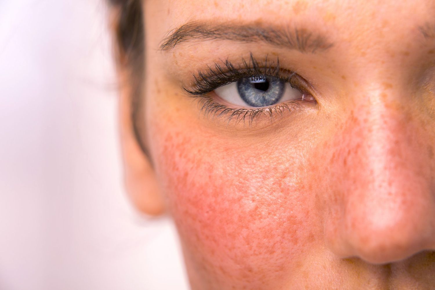Treating Rosacea with Compounded Dermatology