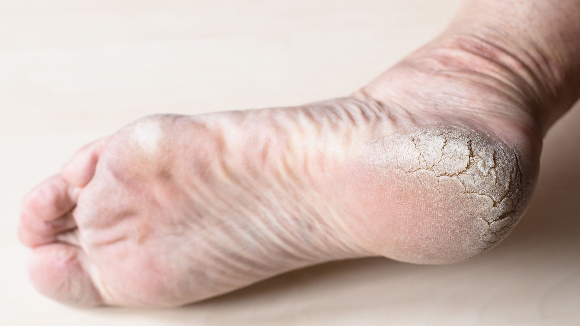 Compounded Dry Cracked and Thickened Foot Skin Treatments