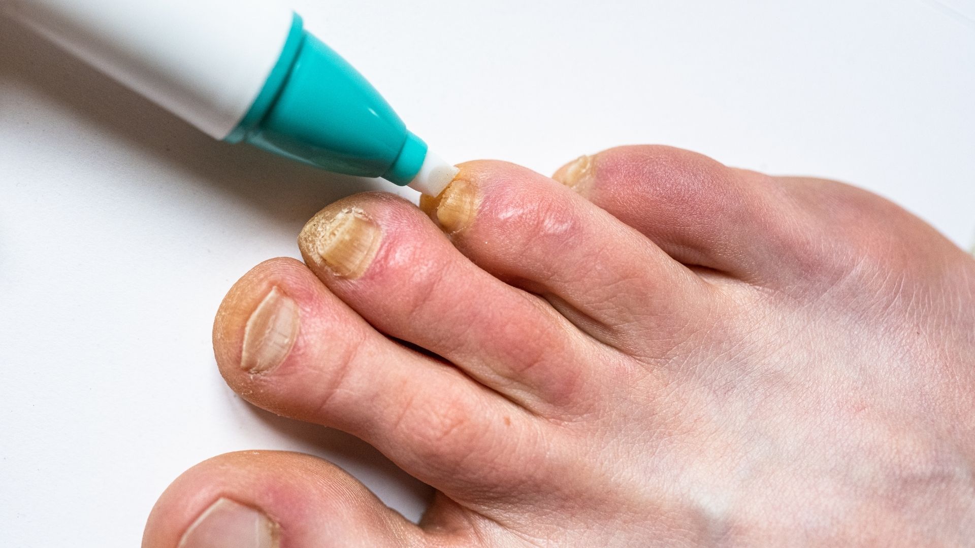 Compounded Fungal Foot and Skin Treatments