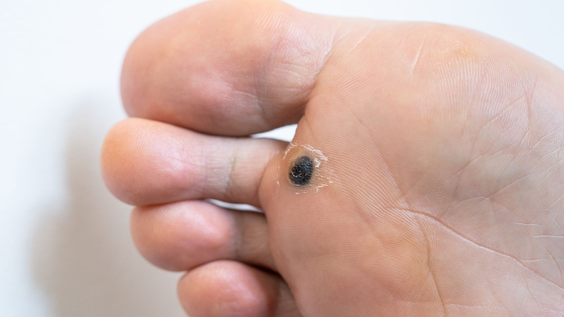 Compounded Plantar Wart Treatments